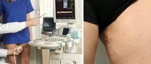 symptômes de varices du petit bassin